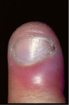 Paronychial Infection